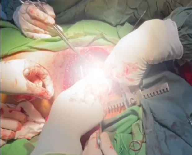 نجات جان جوان ۱۵ ساله در اثر آسیب به بطن چپ قلب در بیمارستان فاطمی اردبیل