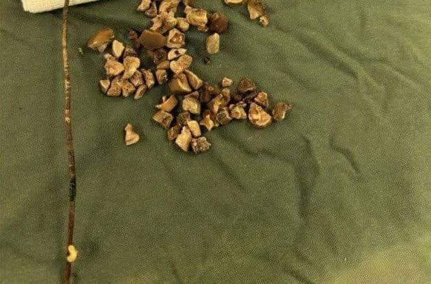 خارج کردن کاتتر دبل جی پس از ۱۰ سال
